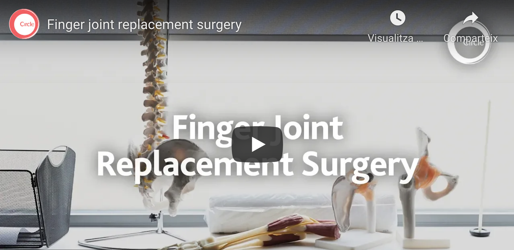 Finger joint replacement video interview to Dr. Zulfi Rahimtoola Dr
